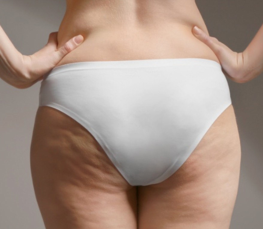 quels sont les traitements anti-cellulite à Saint-Avold