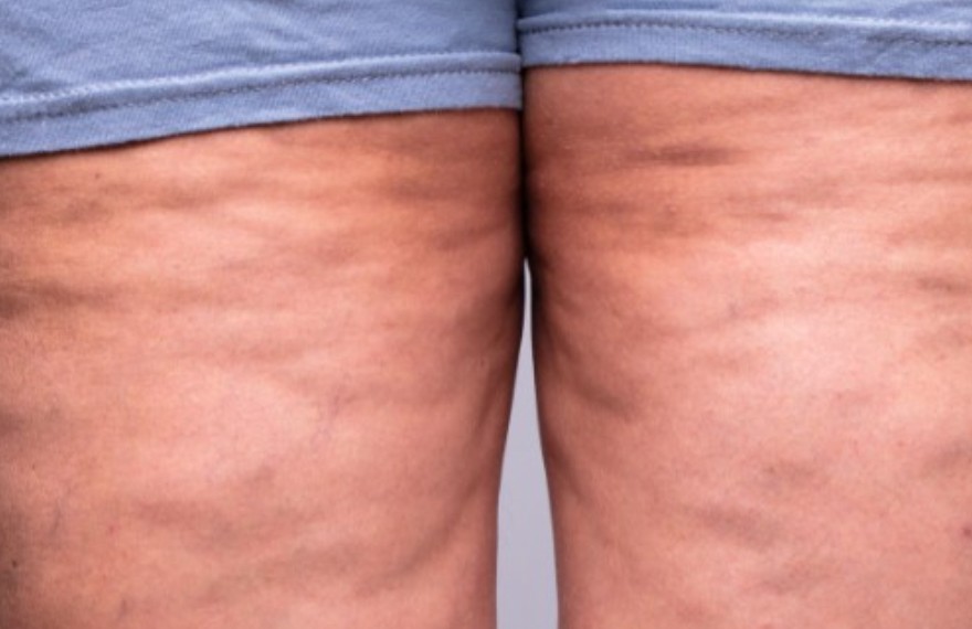 traitement anti-cellulite saint-avold