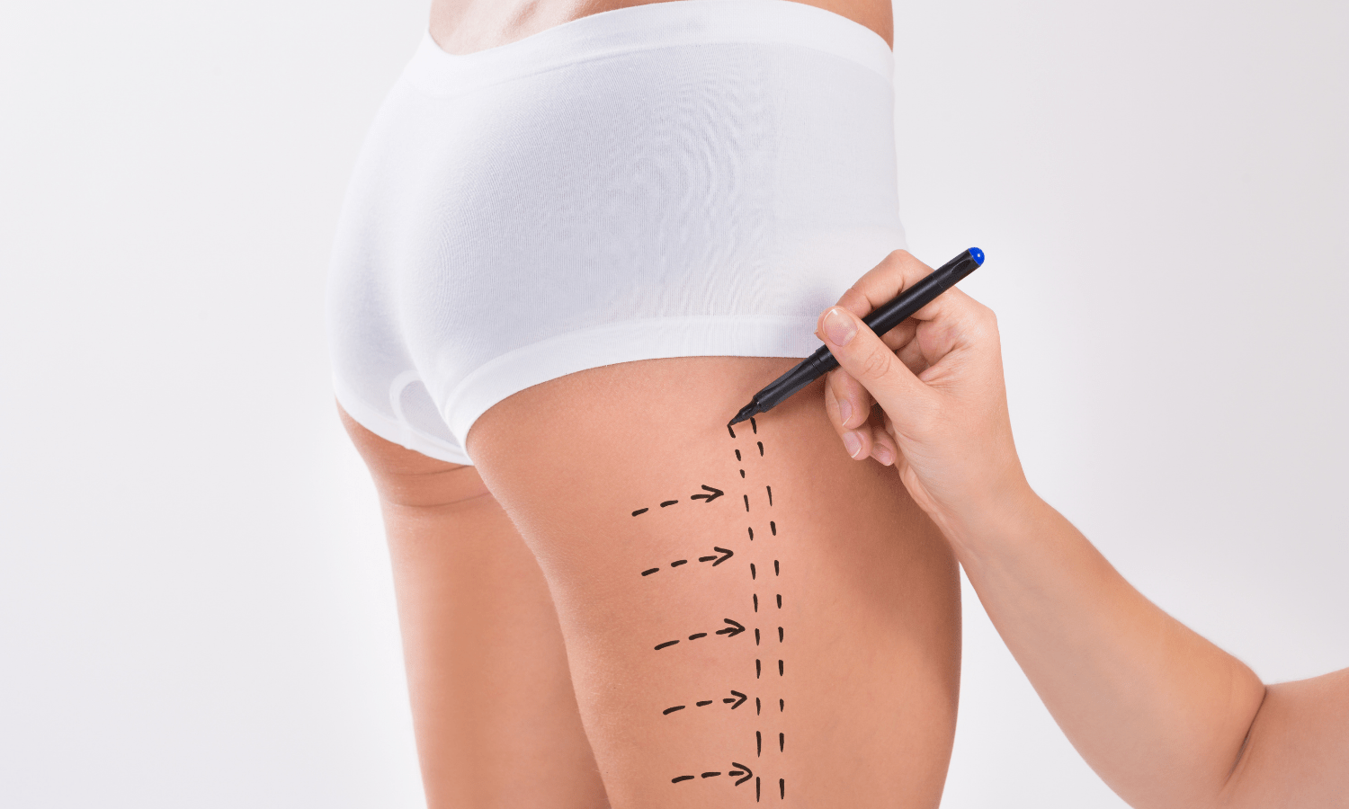 traitement anti cellulite saverne